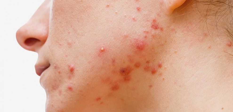 Nitrous oxide adverse effects