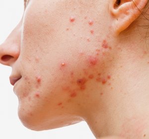 Nitrous oxide adverse effects